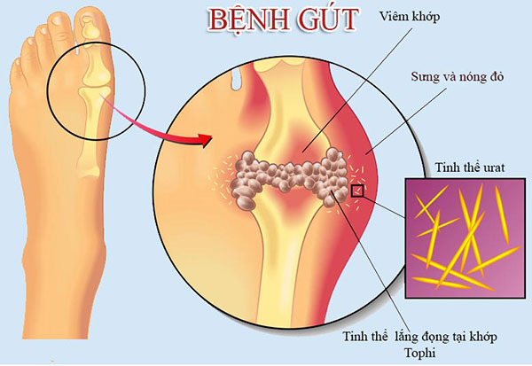 Viên uống hỗ trợ điều trị Gút The Goutto Ribeto Nhật Bản 1