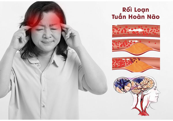 Viên uống tuần hoàn não, ngừa đột quỵ Ichoha Ekisu Plus của Ribeto (3)